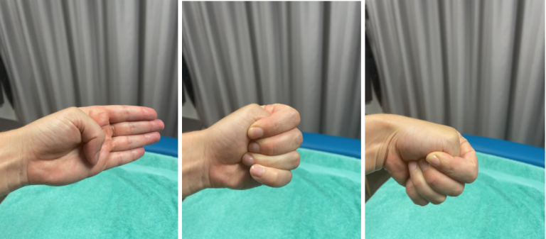 Finkelstein test hand positions De Quervains