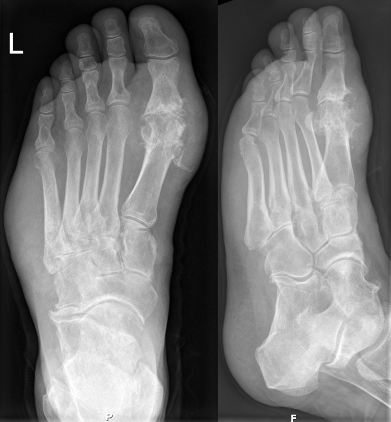 Gout xray