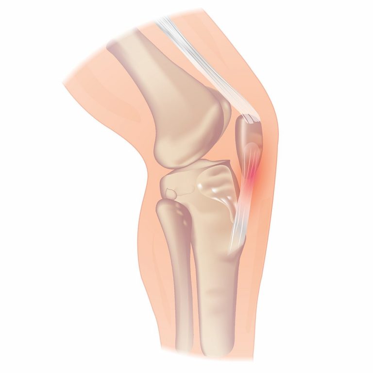 Patellar Tendinopathy diagram