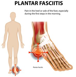 plantar fasciitis foot pain